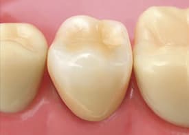 北千住デンタルクリニックで、保険で白い歯を